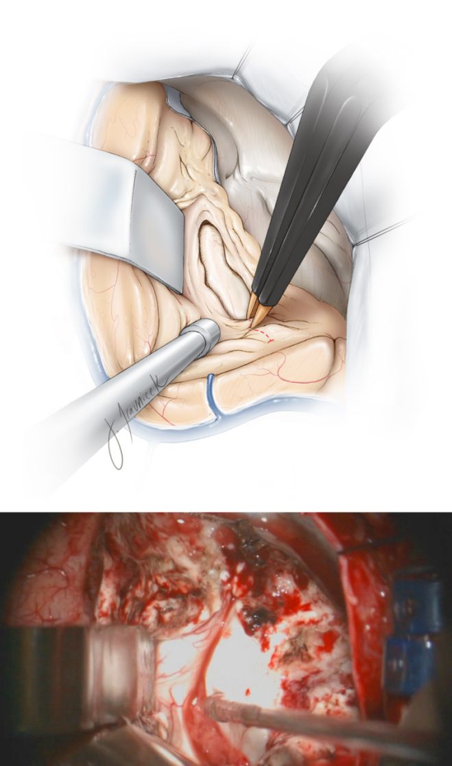 颞叶前内侧切除手术策略与技巧theneurosurgicalatlas全文翻译