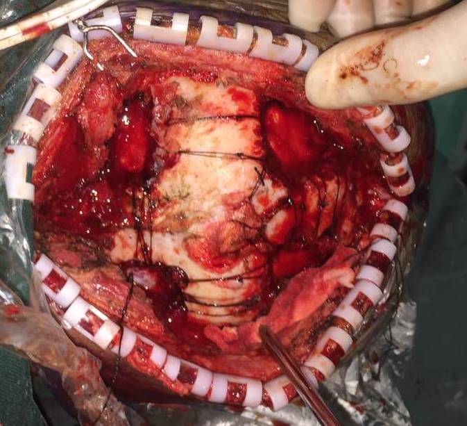 颅脑创伤神经重症病例周刊第14期枕部跨窦巨大硬膜外血肿致呼吸骤停