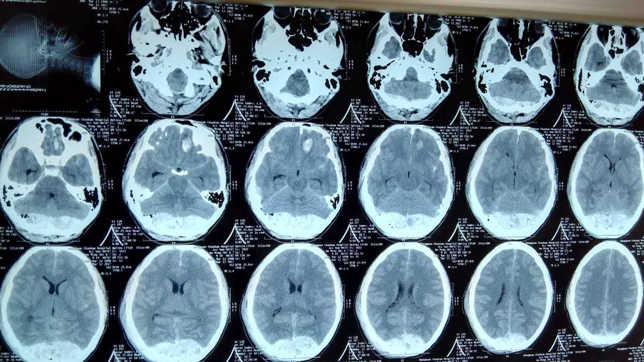 顱腦創傷神經重症病例週刊第14期枕部跨竇巨大硬膜外血腫致呼吸驟停