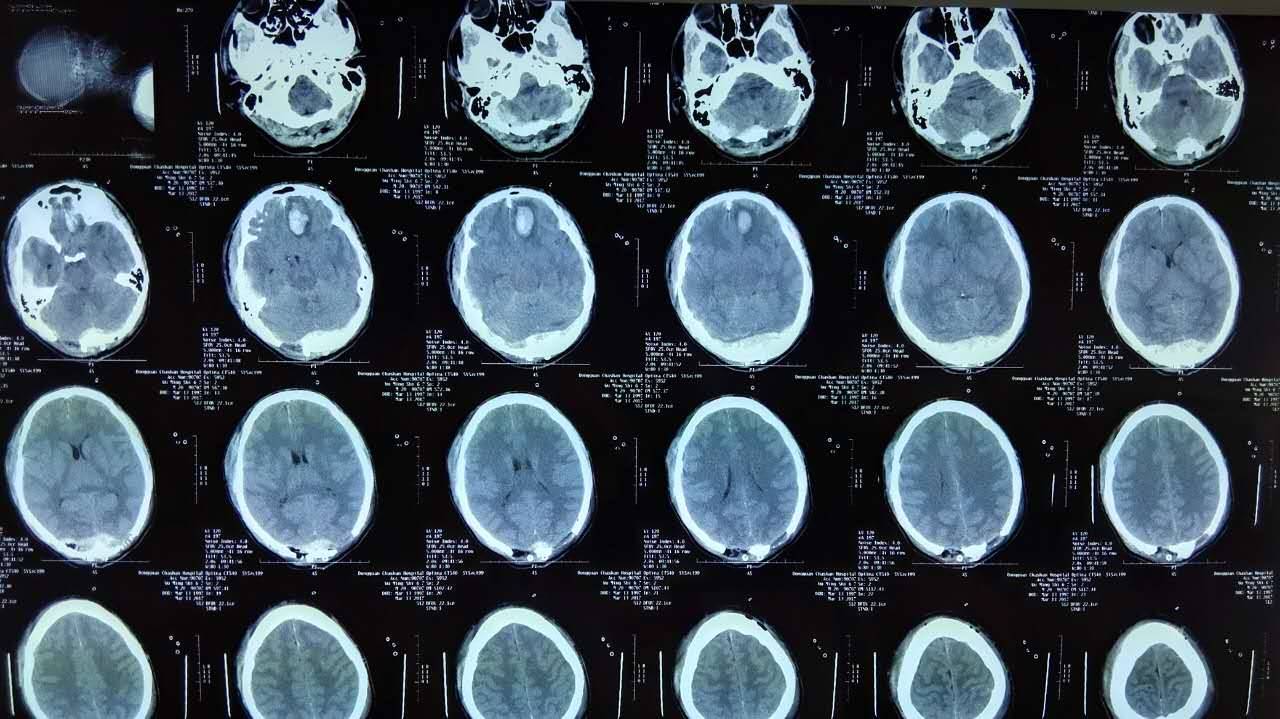3月28日ct见血肿基本吸收,头部伤口已拆线,人扶下行走时头晕明显,4月1