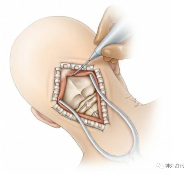 采用单极电凝分离附着在上项线的肌肉,将肌肉从骨膜下方抬高,从而使其