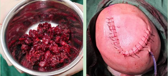 崎胎瘤 手术图片