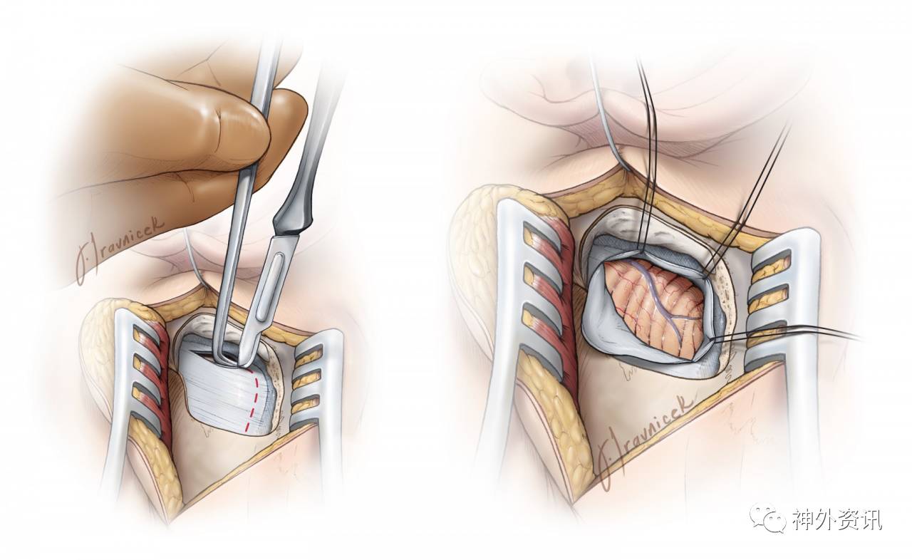 乙状窦后入路theneurosurgicalatlas系列