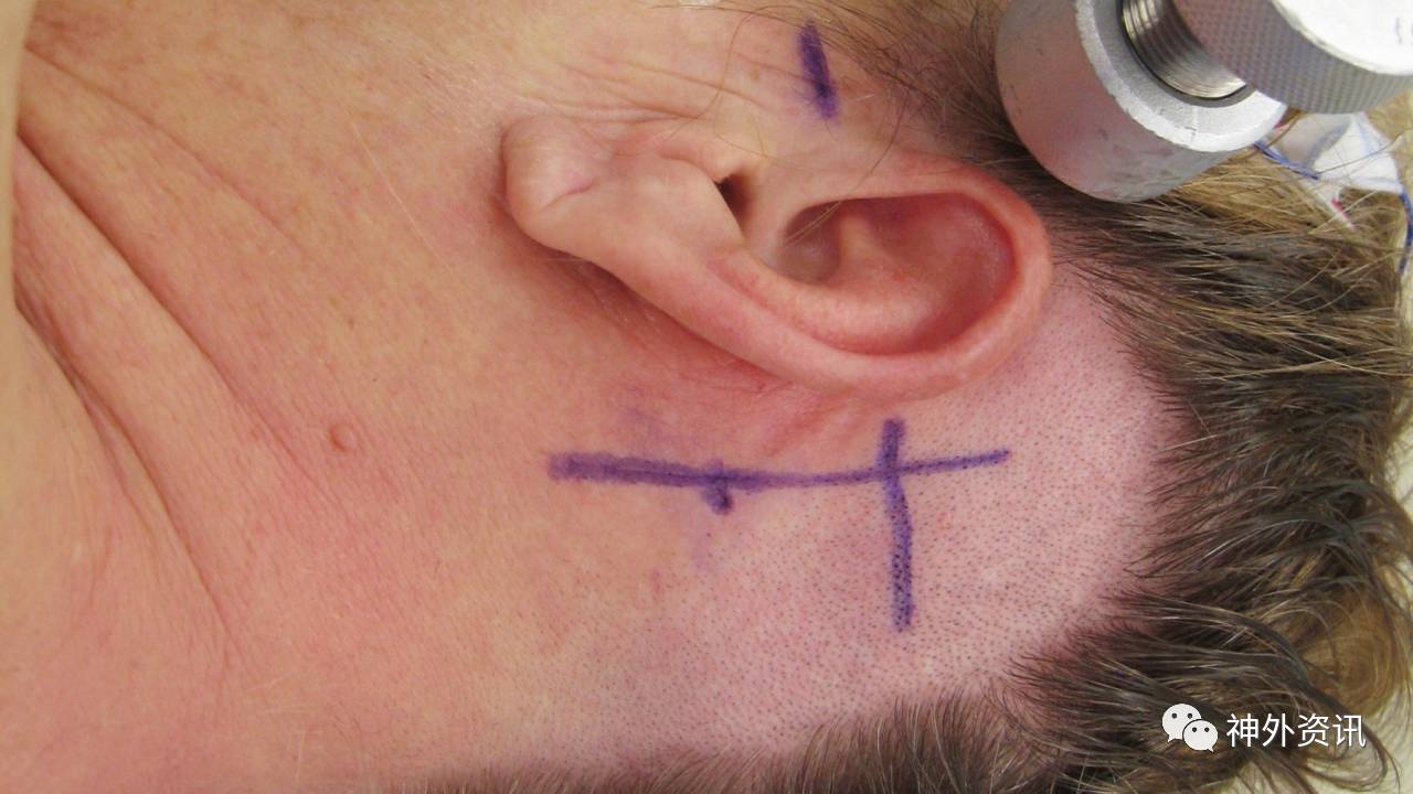 直线形切口广泛用于微血管减压术及切除小的桥小脑角肿瘤,切口的1/3