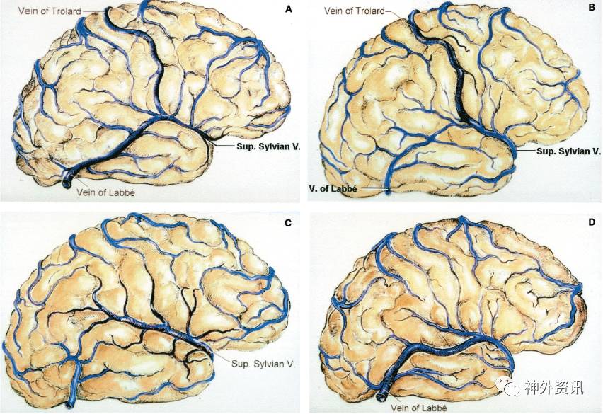 勘误侧裂浅静脉supsylvianv的前世今生