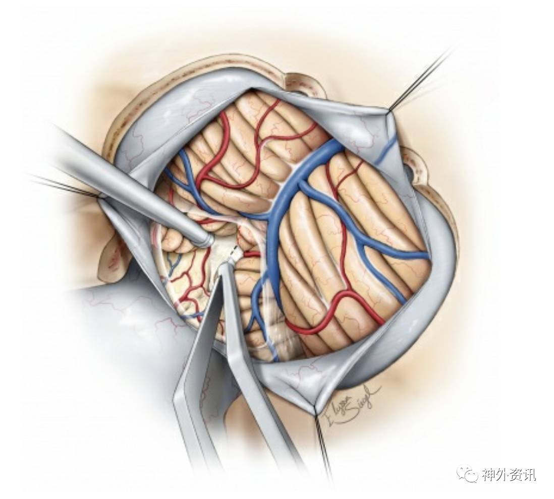 膜帆入路操作技巧theneurosurgicalatlas全文翻译