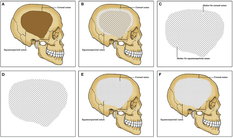 三维钛网是什么【精选编译】颅骨修补术中采用冠状缝和鳞顶缝作为钛板3D塑型的标志_https://www.jmylbn.com_新闻资讯_第3张