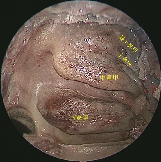 鼻腔侧壁切除中鼻甲后观察鼻腔内整体空间形态(点击图片即可查看大图)