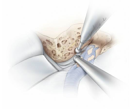 位於斜坡下1/3及枕骨大孔區的病變則更適於通過乙狀竇後入路及/或遠