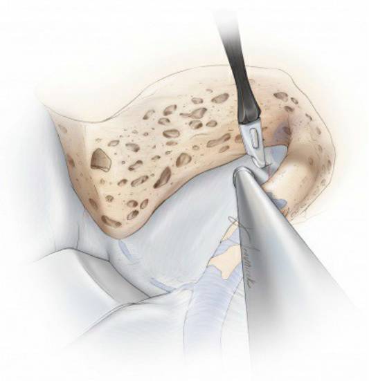标准经岩骨后方入路操作技巧丨theneurosurgicalatlas全文翻译