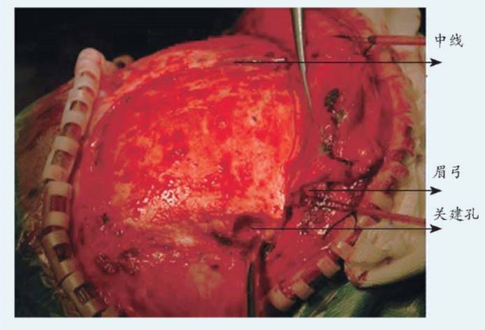 吴斌教授:冠状切口额部开颅