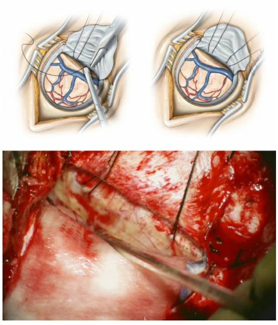 對側縱裂經大腦鐮經楔前葉入路手術策略與技巧丨theneurosurgical