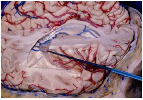 對側縱裂經大腦鐮經楔前葉入路手術策略與技巧丨theneurosurgical