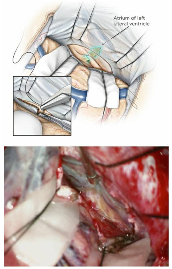对侧纵裂经大脑镰经楔前叶入路手术策略与技巧丨theneurosurgical