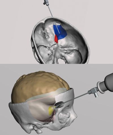 endoscope-assisted repair of csf otorrhea and temporal lobe