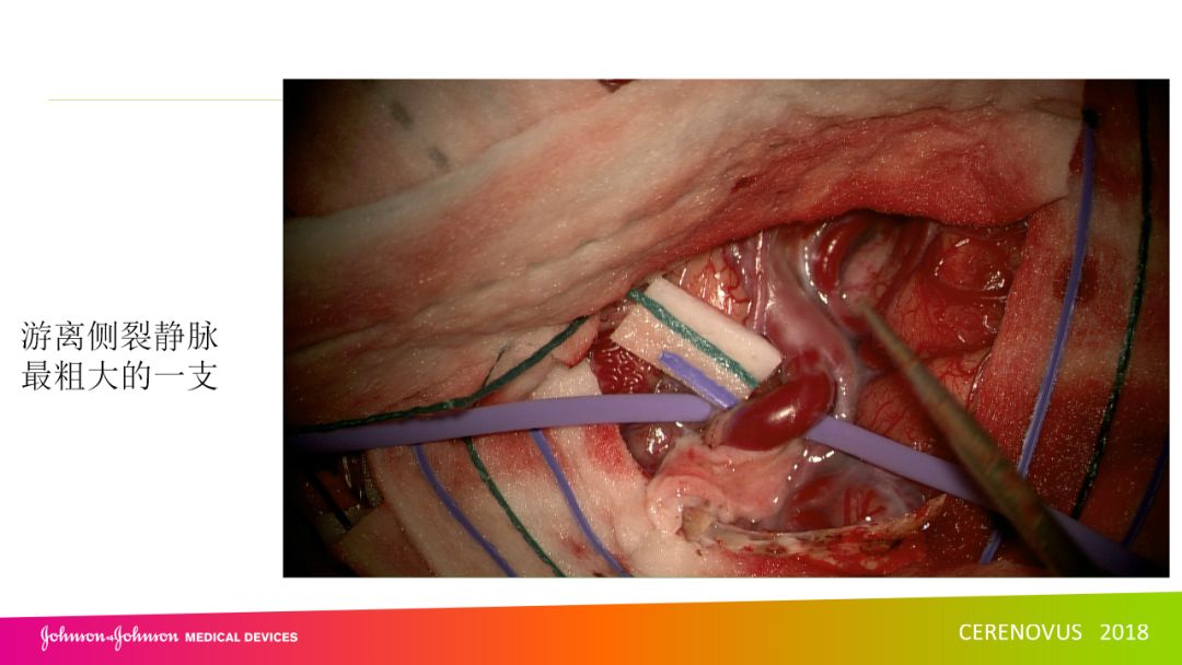吕明教授复合手术治疗海绵窦区硬脑膜动静脉瘘一例