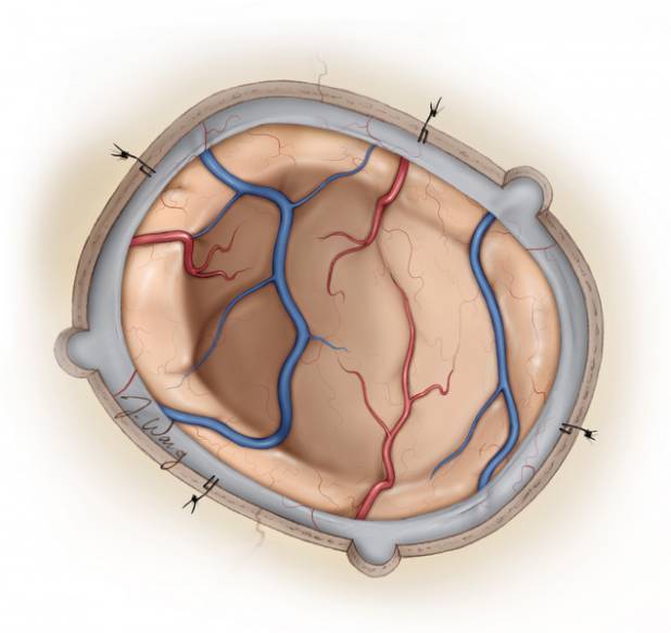 凸面脑膜瘤手术策略与技巧theneurosurgicalatlas全文翻译