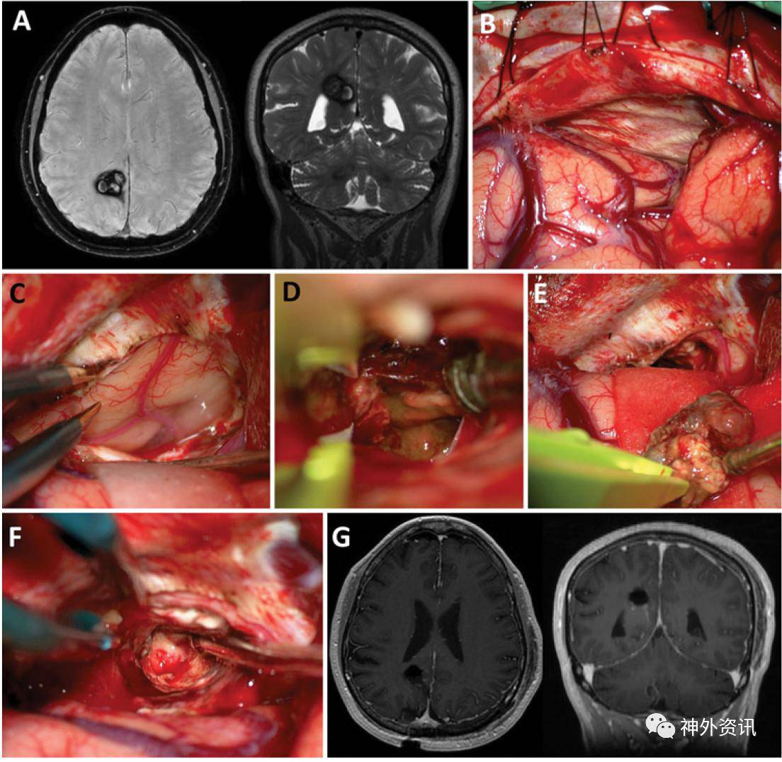 經對側後縱裂入路切除頂枕葉內側面深部血管畸形