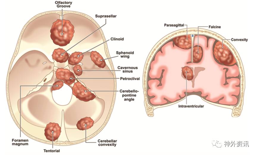 脑膜瘤示意图图片