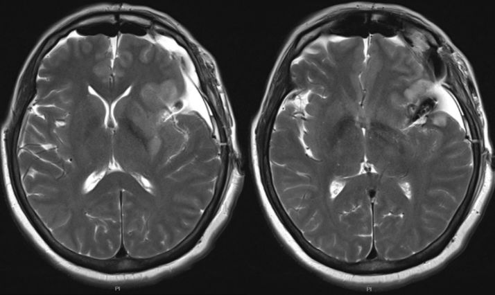 动脉瘤可能,行头颅cta提示为左侧大脑中动脉巨大动脉瘤,头颅dsa检查