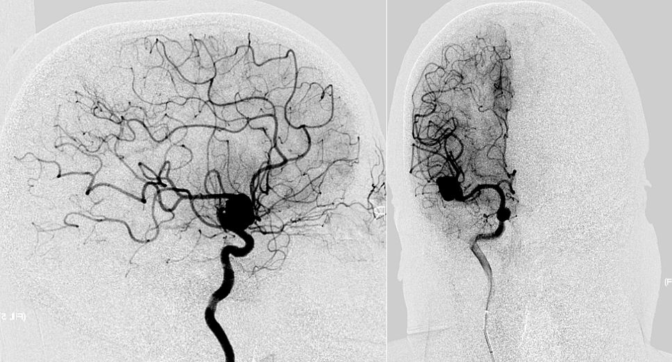 何升学副主任医师三例大脑中动脉瘤病例分享