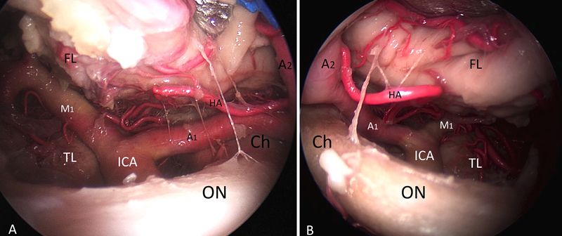 内镜下经鼻经鞍结节蝶骨平台入路的外侧边界解剖