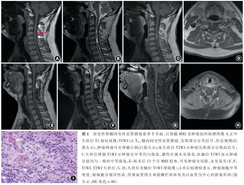 原发性脊髓间变性室管膜瘤的临床特点和诊治中华神外2018年第一期临床
