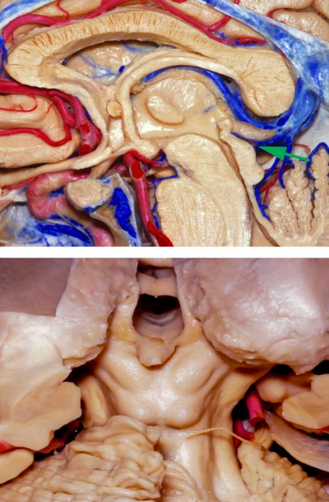 图2. 图为三脑室后部一中等分化松果体实质肿瘤(上排图).