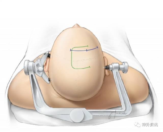 经纵裂入路开颅手术操作技巧丨theneurosurgicalatlas全文翻译