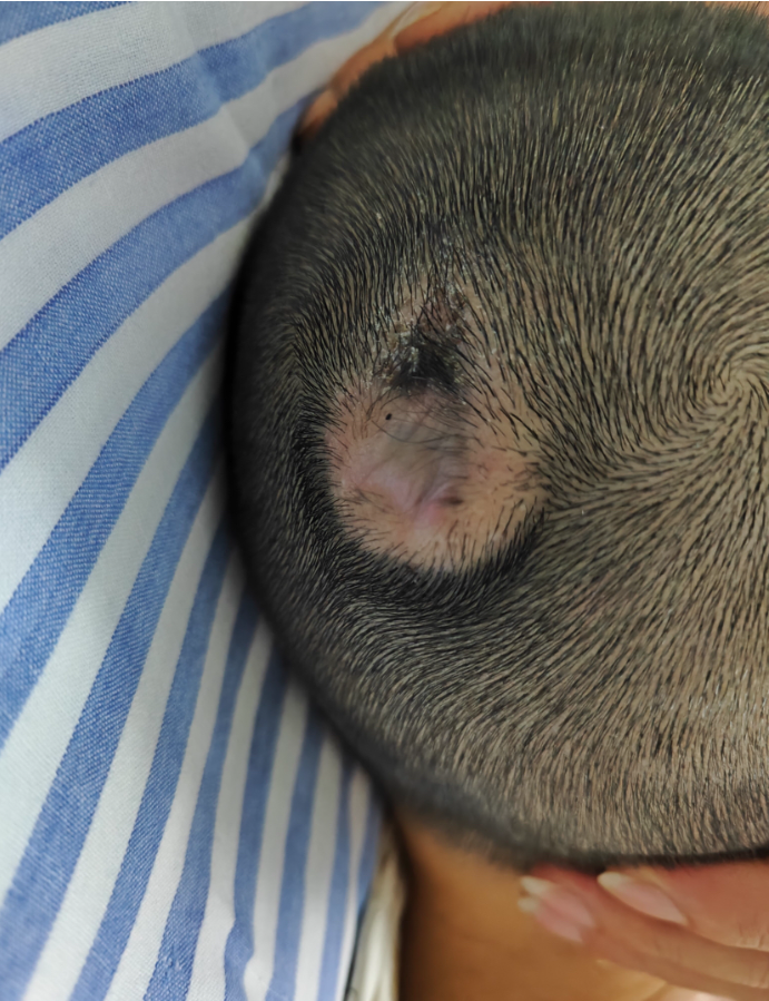 手术头皮夹怎么放【病例分享】刘国平主任医师：一例枕部脑膜脑膨出的手术治疗_https://www.jmylbn.com_新闻资讯_第3张