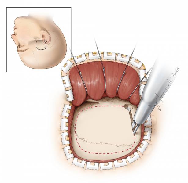 对于马蹄形切口,使用鱼钩往下牵开皮肌瓣,直至能够清晰显露颧弓后跟.