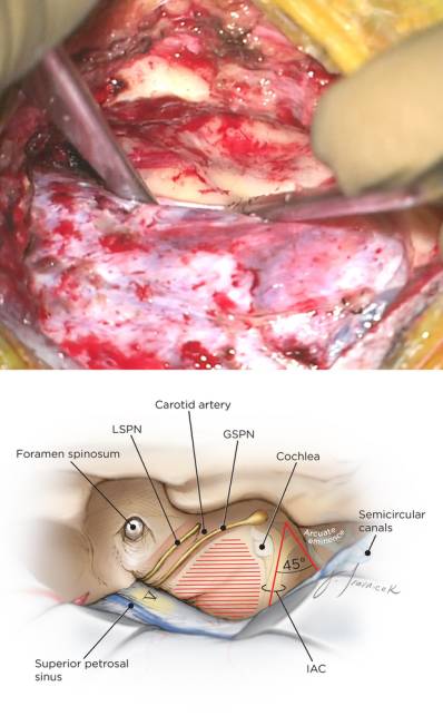 前岩骨切除手术技巧丨theneurosurgicalatlas全文翻译