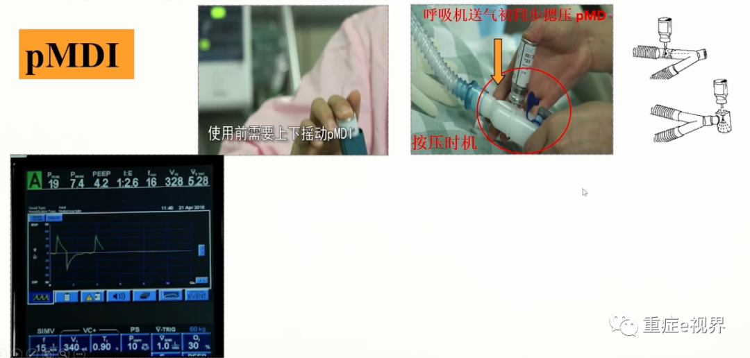 有创呼吸机怎么做雾化气道雾化吸入疗法需要关注的问题_https://www.jmylbn.com_新闻资讯_第23张