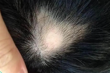 成都中研皮肤研究院秋冬季节性斑秃的出现，到底是因为什么？