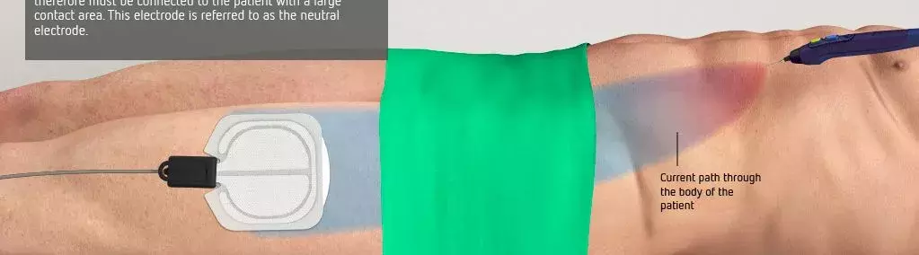 为什么手术用电刀手术室高频电刀安全与负极板那些事_https://www.jmylbn.com_新闻资讯_第3张