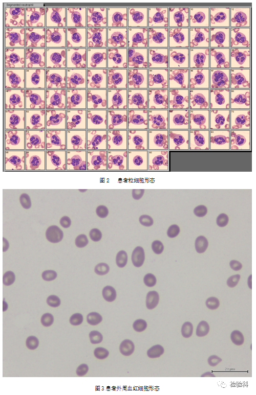 塗片染色經全自動數字圖像分析系統讀取後發現中性粒細胞絕大部分胞體