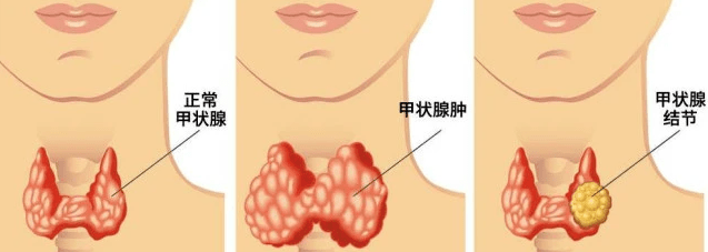 怀孕女性手瘾有危害_女性甲亢早期症状_女性甲亢的危害有多大