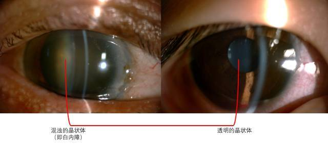 什么是裂隙灯【眼科检查】裂隙灯显微镜检查是什么？_https://www.jmylbn.com_新闻资讯_第12张