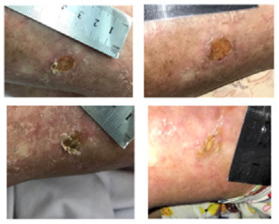 脐带血的超能力——移植异基因造血干细胞后出现皮肤排异反应,用它