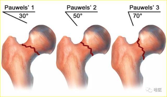 股骨颈骨折 比pauwels角更可靠的股骨颈垂直角 骨科文献 微信公众号文章阅读 Wemp