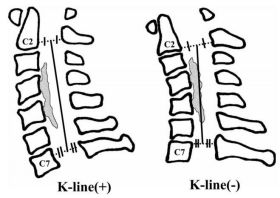 與時俱進談K-line——K-Line在OPLL中運用的再認識 科技 第3張