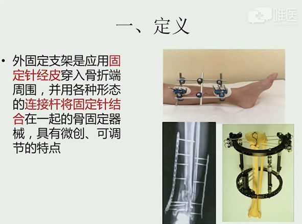 什么是外固定架深入讲解外固定支架_https://www.jmylbn.com_新闻资讯_第3张