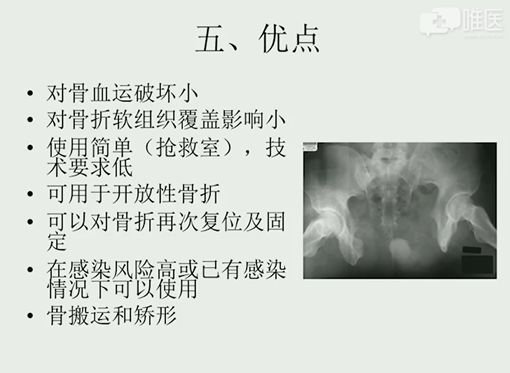 什么是外固定架深入讲解外固定支架_https://www.jmylbn.com_新闻资讯_第7张