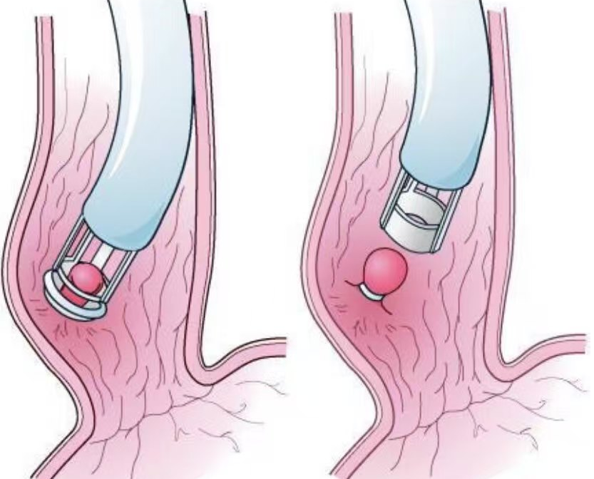 套扎器是什么微创治痔！内痔套扎术，告别难言之隐_https://www.jmylbn.com_新闻资讯_第2张