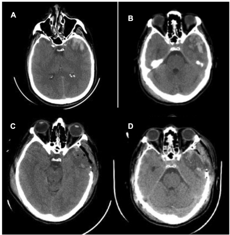 腰穿有什么用病例系列报道——使用控制性腰穿引流治疗基底池未闭的难治性颅内高压_https://www.jmylbn.com_新闻资讯_第5张