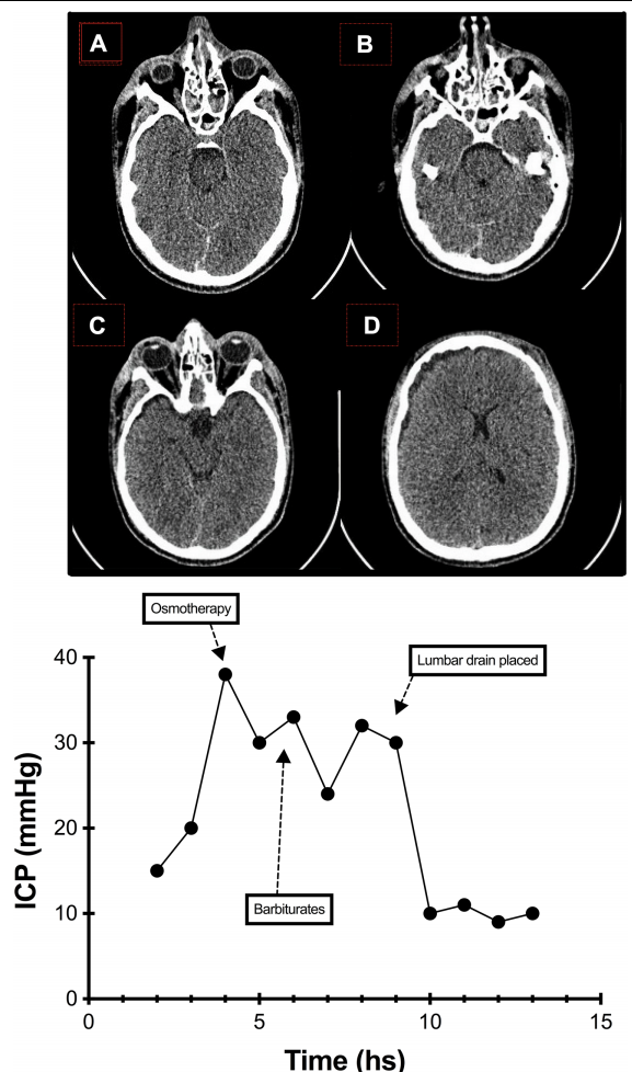 腰穿有什么用病例系列报道——使用控制性腰穿引流治疗基底池未闭的难治性颅内高压_https://www.jmylbn.com_新闻资讯_第2张