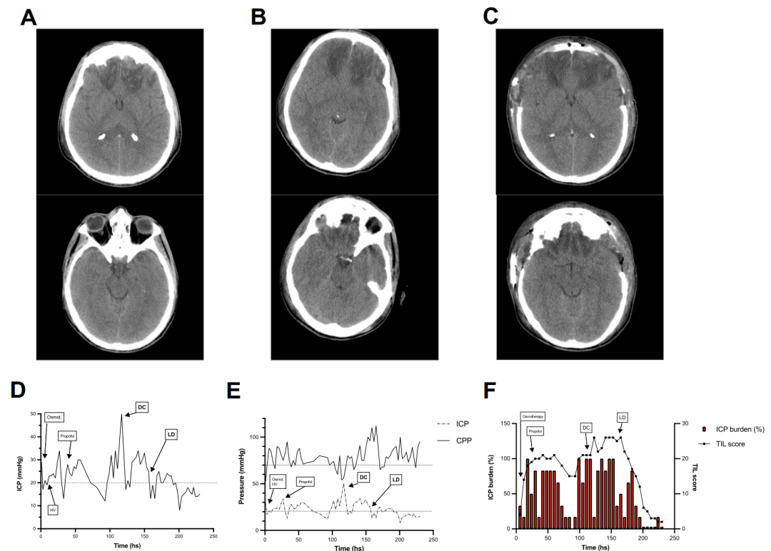 腰穿有什么用病例系列报道——使用控制性腰穿引流治疗基底池未闭的难治性颅内高压_https://www.jmylbn.com_新闻资讯_第8张