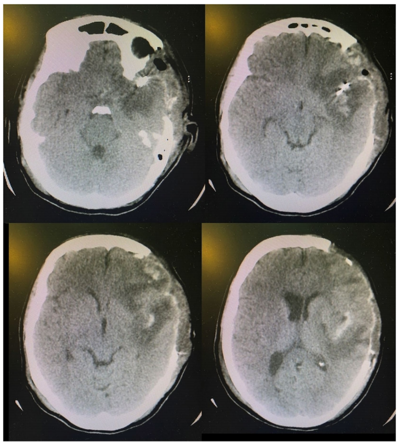 腰穿有什么用病例系列报道——使用控制性腰穿引流治疗基底池未闭的难治性颅内高压_https://www.jmylbn.com_新闻资讯_第3张