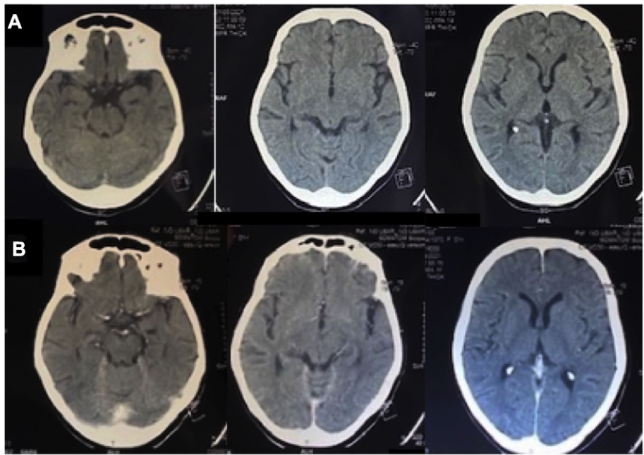 腰穿有什么用病例系列报道——使用控制性腰穿引流治疗基底池未闭的难治性颅内高压_https://www.jmylbn.com_新闻资讯_第6张