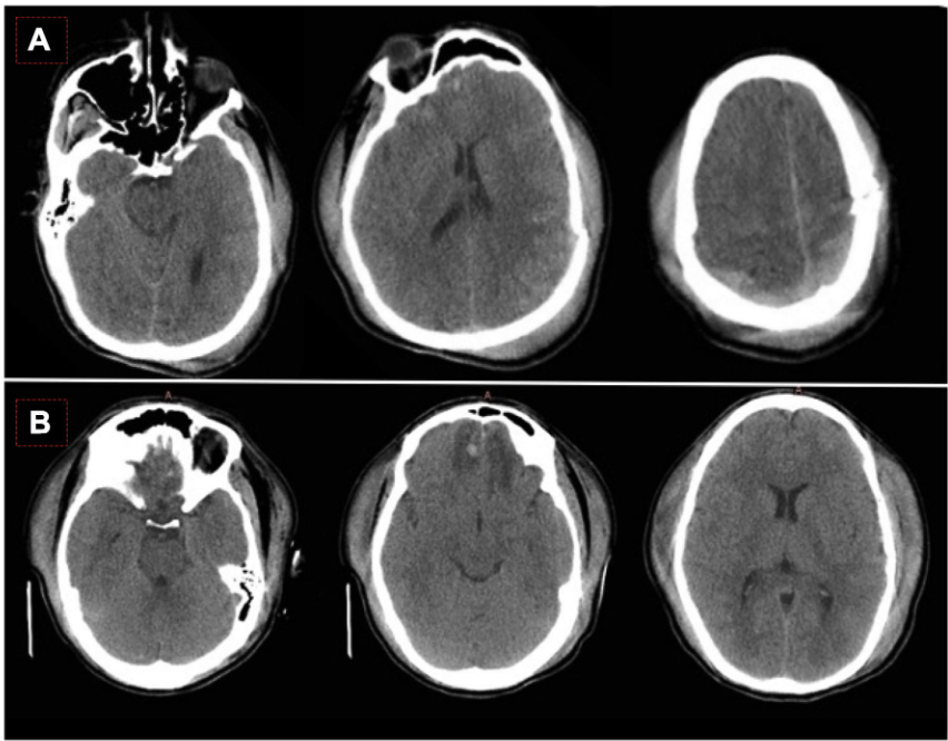 腰穿有什么用病例系列报道——使用控制性腰穿引流治疗基底池未闭的难治性颅内高压_https://www.jmylbn.com_新闻资讯_第7张